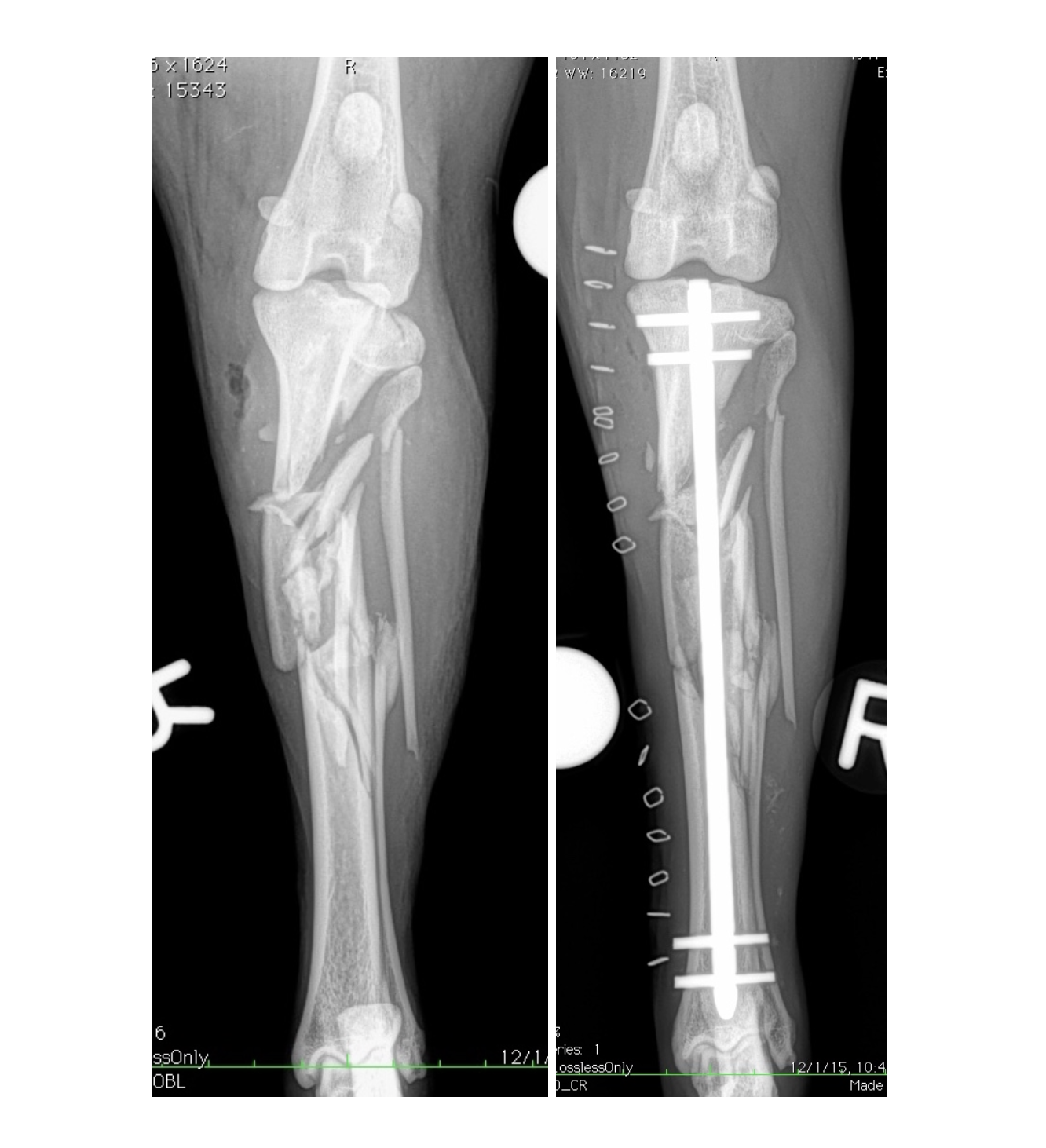Comminuted Tibia fracture pre and postop AP